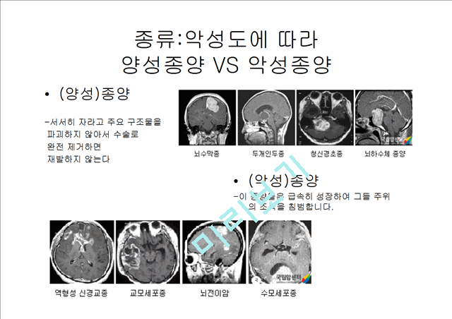 [4000원] 뇌종양종류 및 증상,양성종양 VS 악성종양,뇌종양 수술 방법,뇌종양에 좋은 음식,뇌농양,두부손상,두부손상 응급처치,두부손상에 의한 질환.pptx